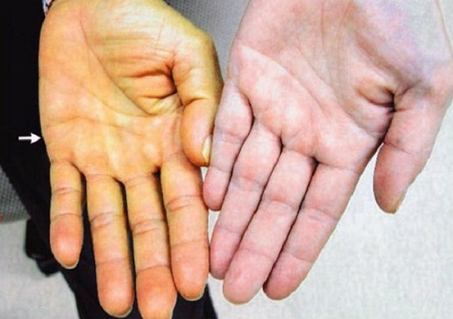 Vàng da là biểu hiện thường thấy của bệnh viêm gan B