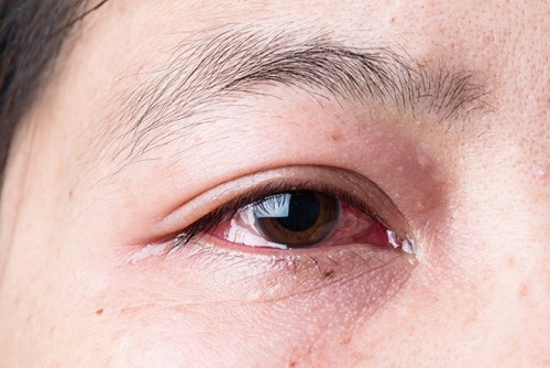 Dấu hiệu nhận biết bệnh đau mắt đỏ dân gian