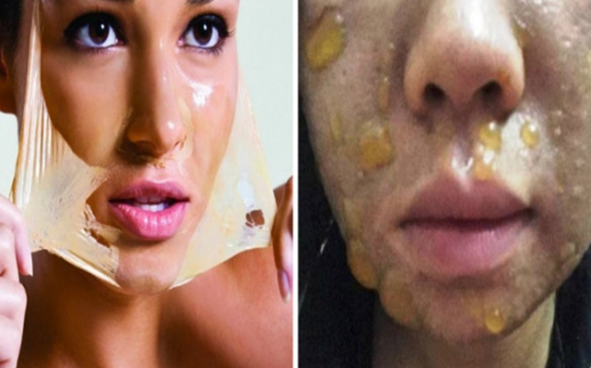 Bỏng nặng toàn khuôn mặt sau khi dùng mỹ phẩm peel da để lột da mặt