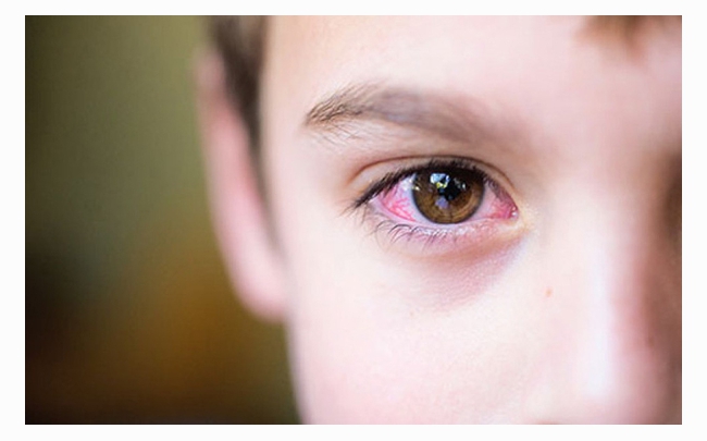 6 cách chữa đau mắt đỏ bằng dân gian đơn giản hiệu quả tại nhà