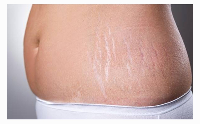 Bật mí: 5 cách trị rạn da sau khi sinh hiệu quả tại nhà