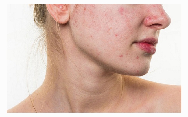 Da mặt bị ngứa và nổi mụn: Nguyên nhân và cách điều trị