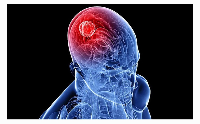 Cẩm nang sức khỏe: Dấu hiệu của bệnh u não là gì?
