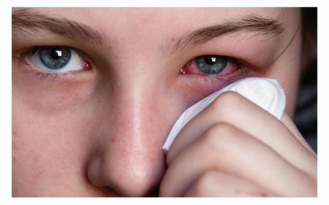Lời khuyên: Đau mắt đỏ kiêng những gì để nhanh khỏi bệnh?