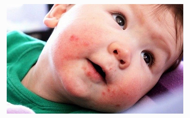 Cảnh báo: Trẻ phát ban đỏ không sốt phải làm sao?